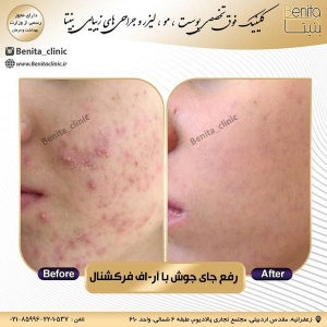 آر-اف-فرکشنال3