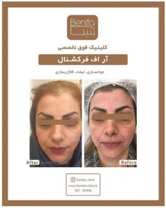 آر-اف-فرکشنال5