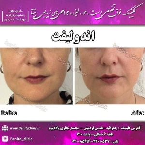 اندولیفت-1