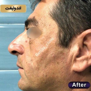 اندولیفت10