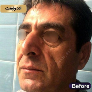 اندولیفت11