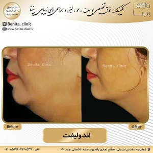 اندولیفت13
