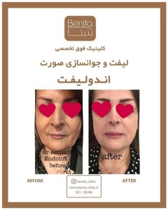 اندولیفت14