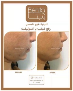اندولیفت15