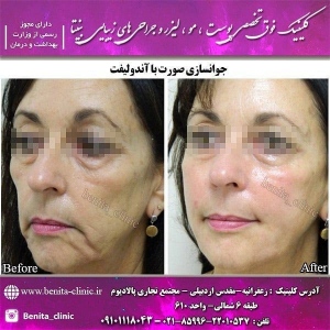 اندولیفت4