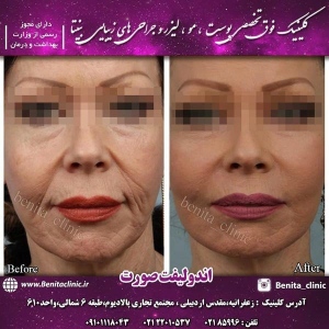 اندولیفت7