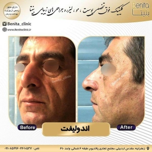 اندولیفت9