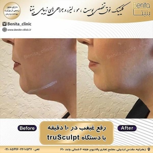 ترواسکالپ1