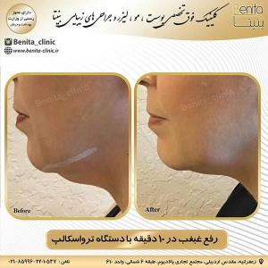 ترواسکالپ2