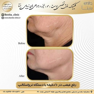 ترواسکالپ3