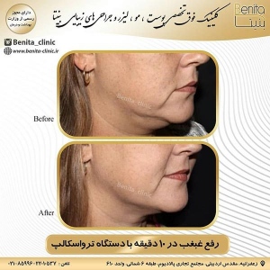 ترواسکالپ4