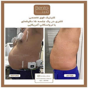 ترواسکالپ6