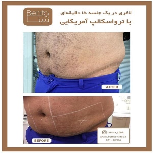 ترواسکالپ7