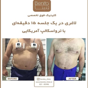 ترواسکالپ8
