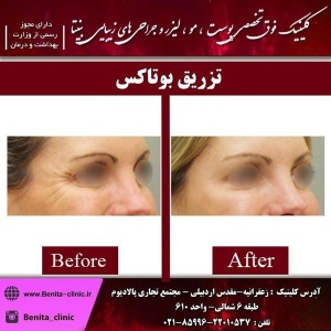 تزریق-بوتاکس1