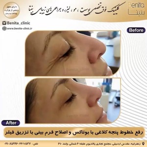 تزریق-بوتاکس10