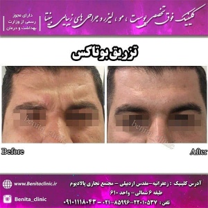 تزریق-بوتاکس2
