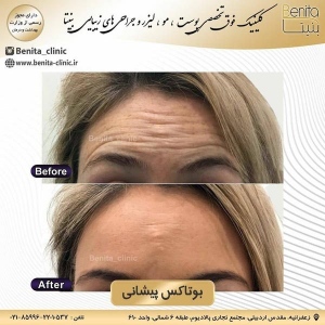 تزریق-بوتاکس4