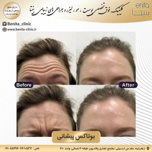 تزریق-بوتاکس5