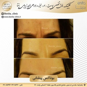 تزریق-بوتاکس6