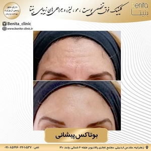 تزریق-بوتاکس7