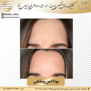 تزریق-بوتاکس8