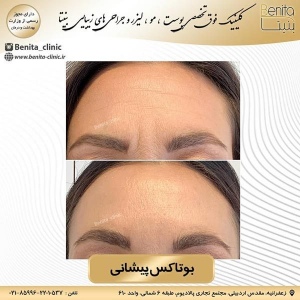 تزریق-بوتاکس9