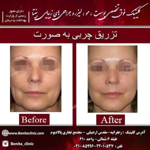 تزریق-چربی1