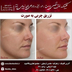 تزریق-چربی3