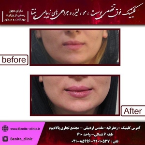 تزریق-ژل-76