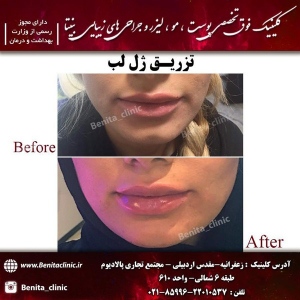 تزریق-ژل-77