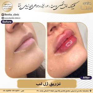 تزریق-ژل-80