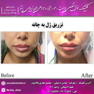 تزریق-ژل10