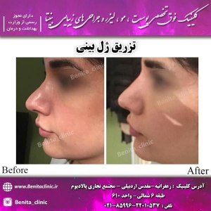 تزریق-ژل11