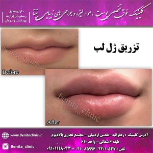 تزریق-ژل12