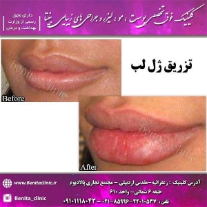 تزریق-ژل13