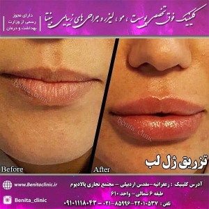 تزریق-ژل14