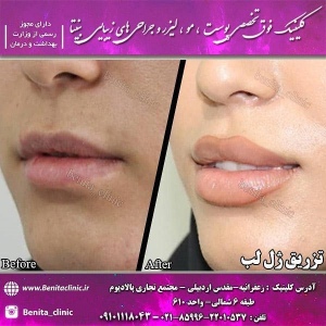تزریق-ژل15