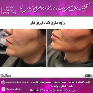 تزریق-ژل16