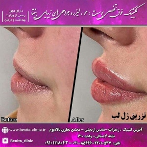 تزریق-ژل17