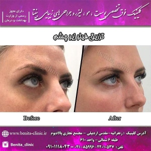 تزریق-ژل18