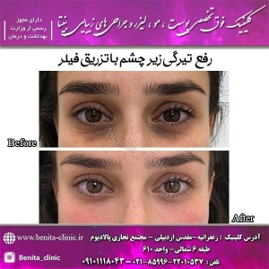 تزریق-ژل19