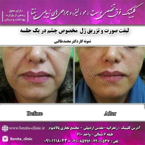 تزریق-ژل20