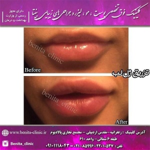 تزریق-ژل21