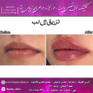 تزریق-ژل22
