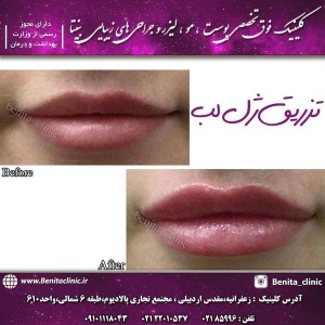 تزریق-ژل23
