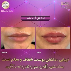 تزریق-ژل24