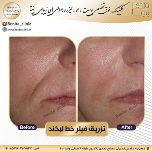 تزریق-ژل25