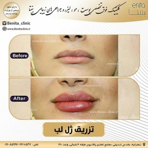 تزریق-ژل26