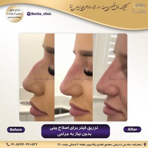 تزریق-ژل27